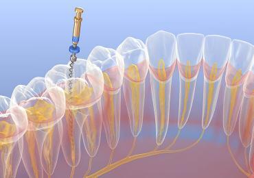 Why should you choose a root canal over tooth extraction?