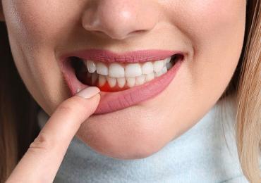 Understanding Gingivitis - Symptoms, Treatment & Prevention
