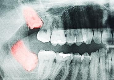 The Importance of Extracting Your Wisdom Teeth: A Wise Decision!