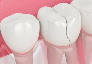Cracked Teeth: A Comprehensive Guide To Causes, Symptoms, And Treatments