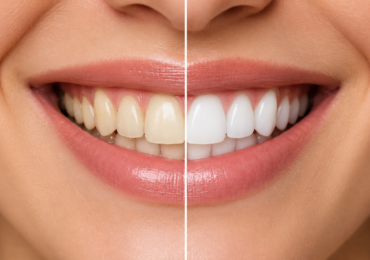 Foods and Drinks That Stain Your Teeth (and What to Do About It)